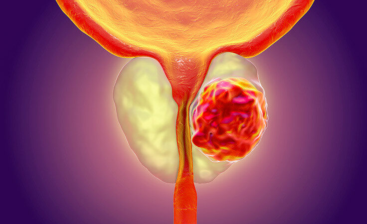 prostatkanseri1